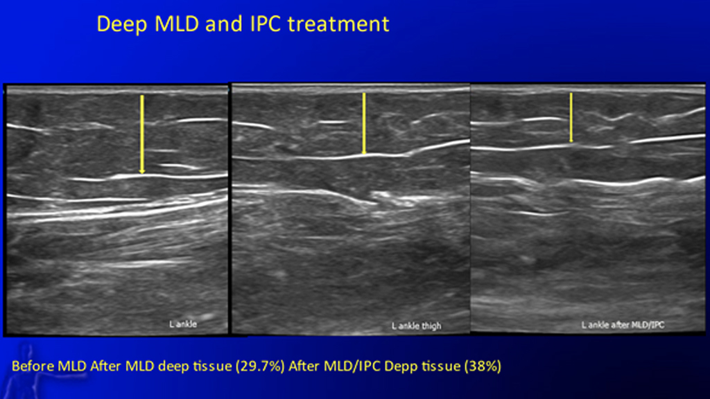 A Conservative and Compassionate Approach to Treating Lymphedema