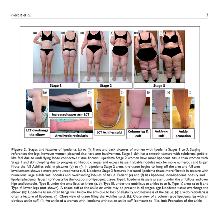 Lipedema_Standard_Of_Care_Image2